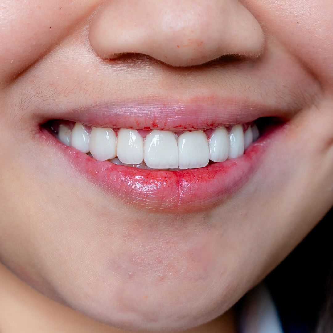 Smile after a Hollywood Smile makeover, with bright, even teeth