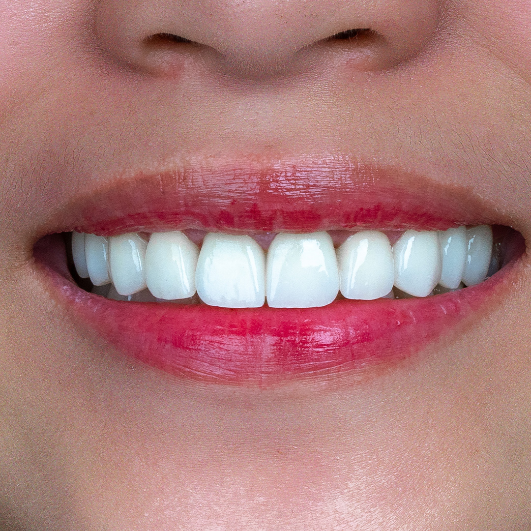Smile after veneers, with even, natural-looking teeth