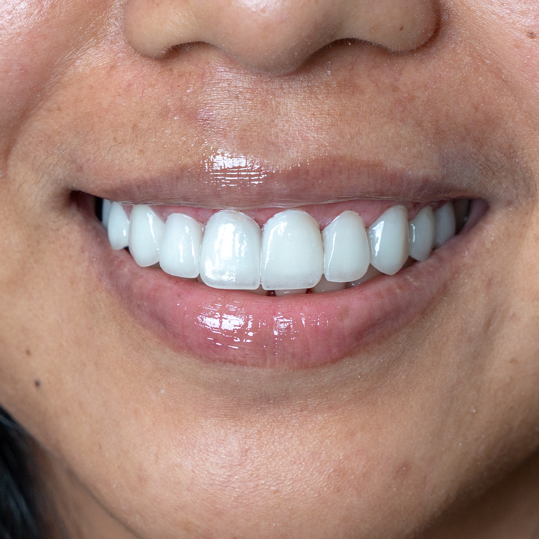 Smile after cosmetic veneers