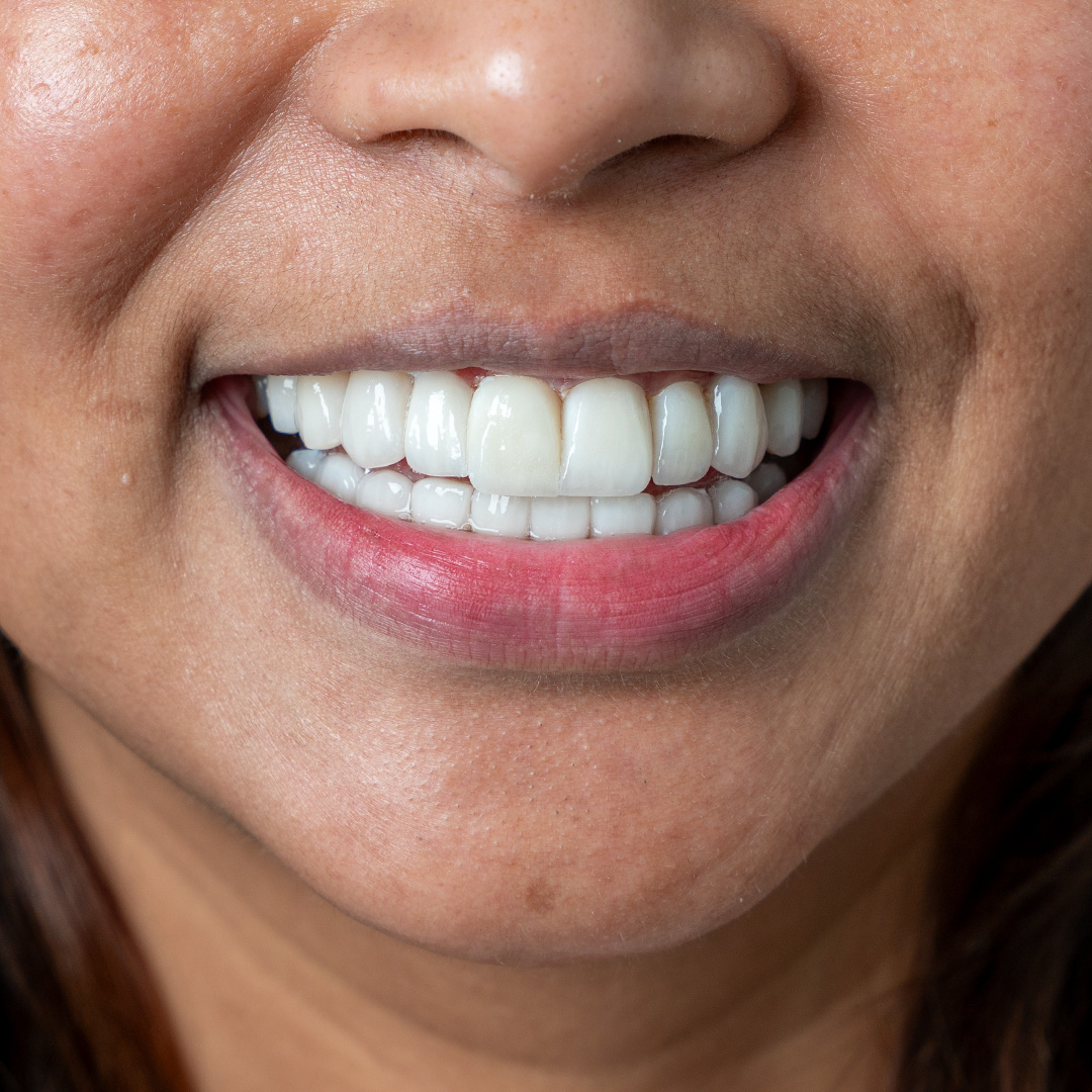 Smile after restorative treatment