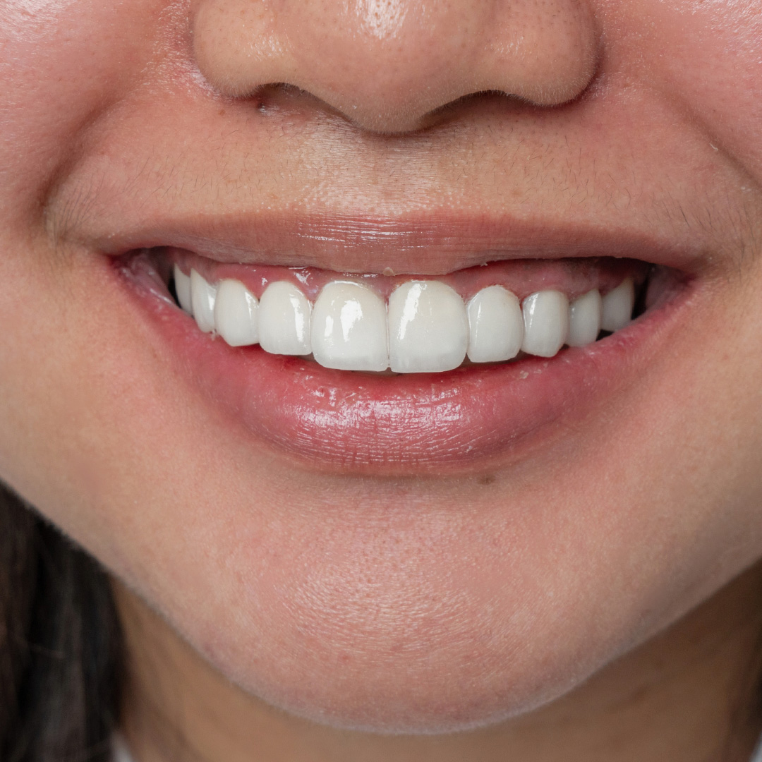 Smile after ceramic veneers