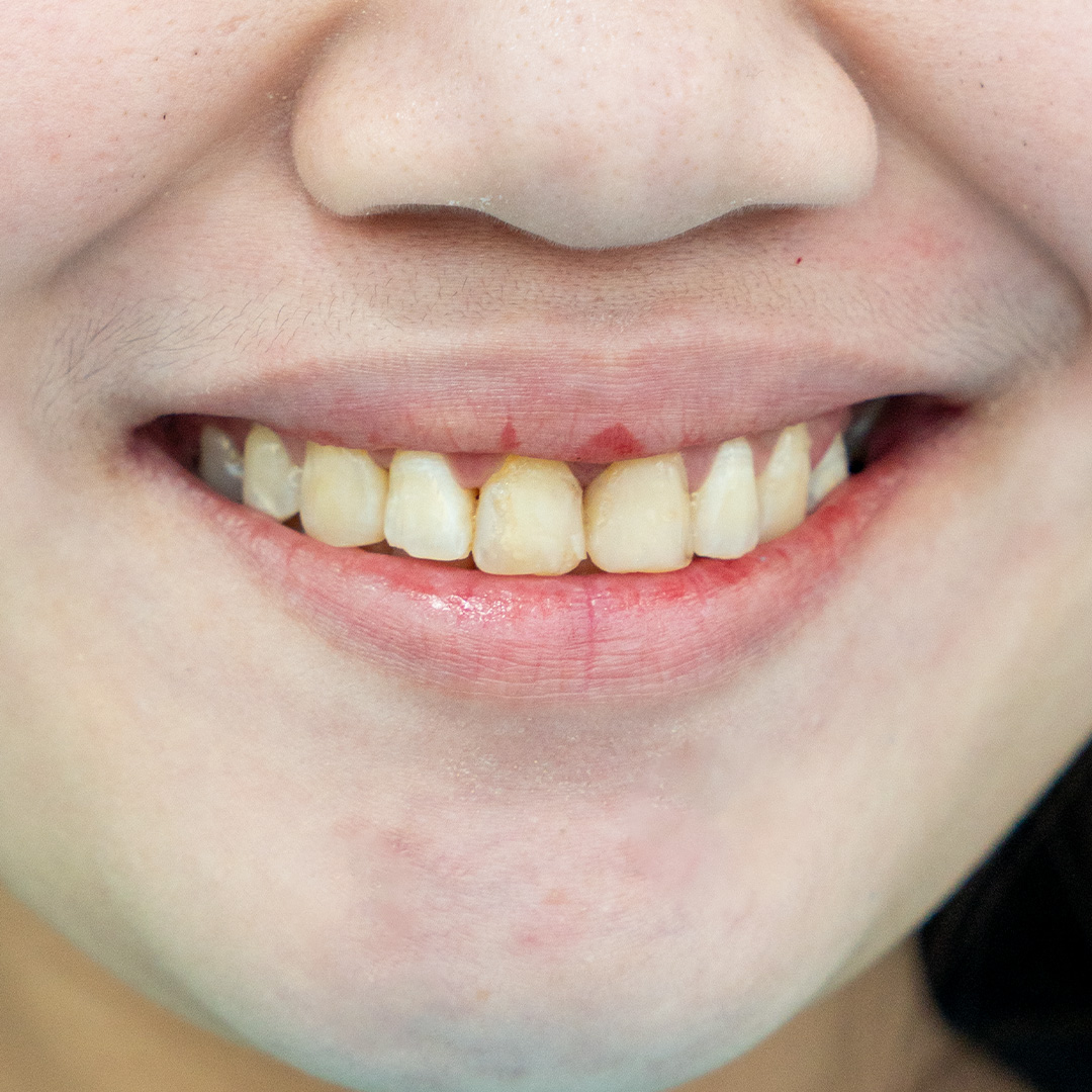 Smile before a Hollywood Smile makeover, with yellowed teeth