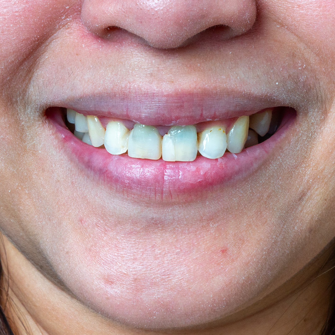 Smile before veneers, with uneven and discolored teeth