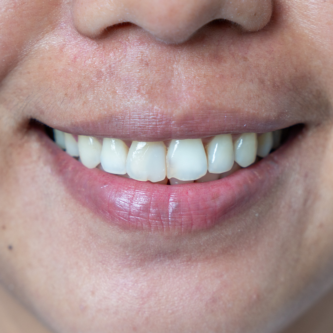 Smile before cosmetic veneers