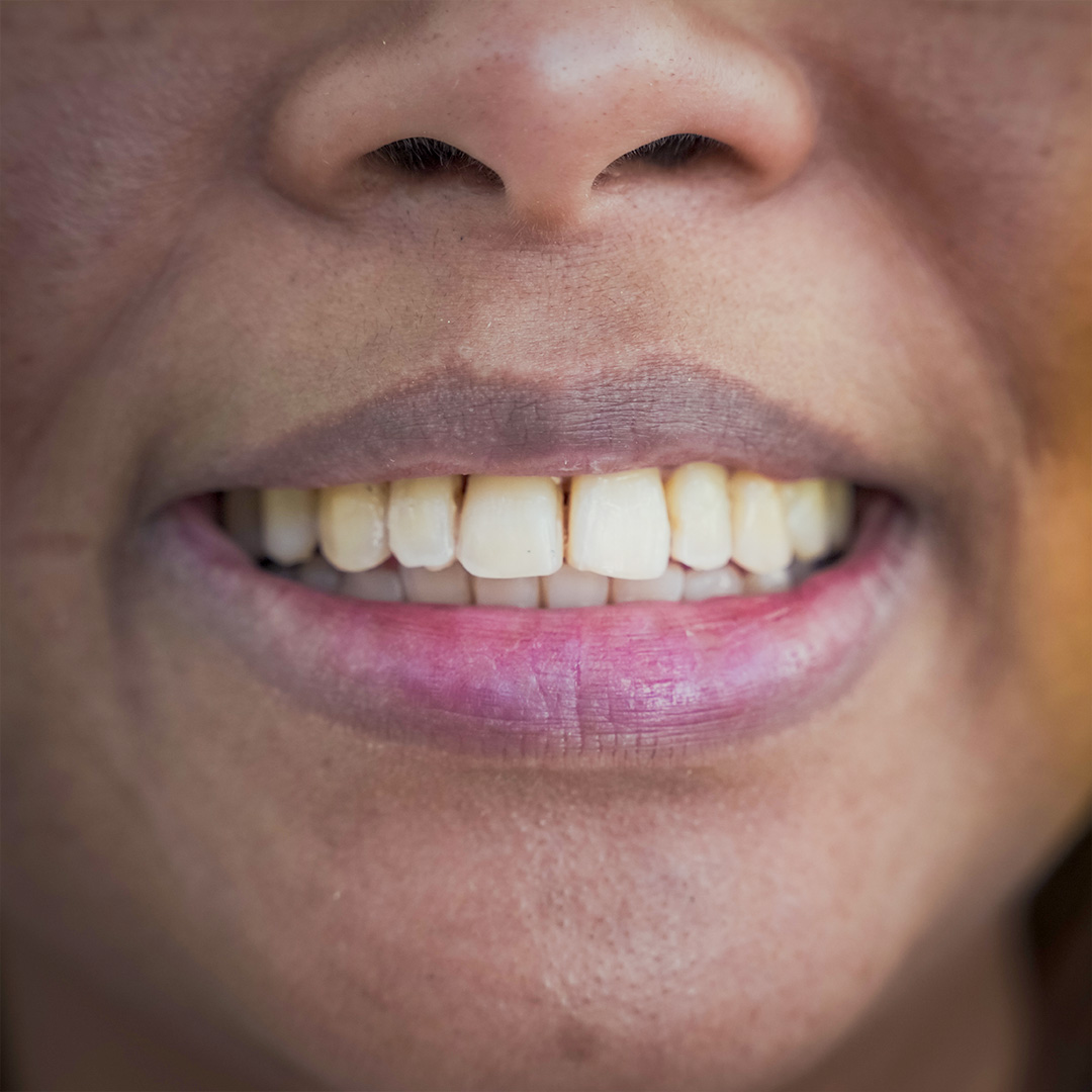 Smile before restorative treatment