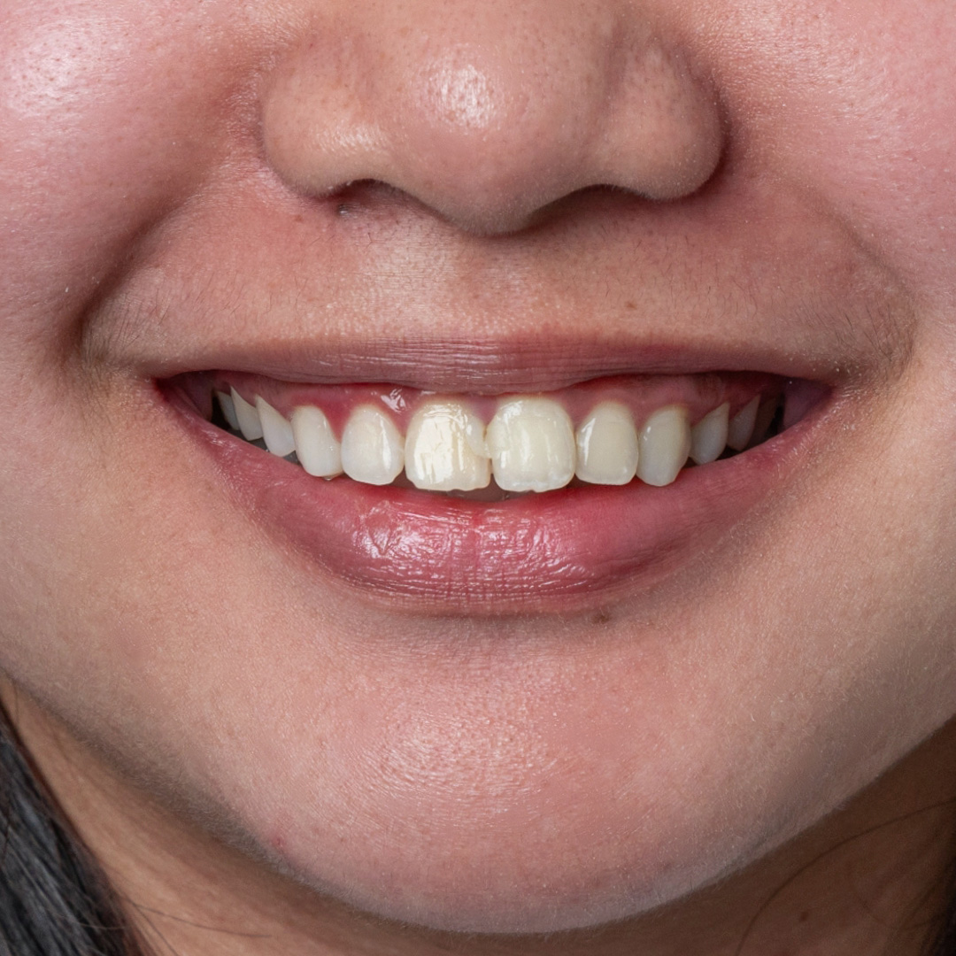Smile before ceramic veneers