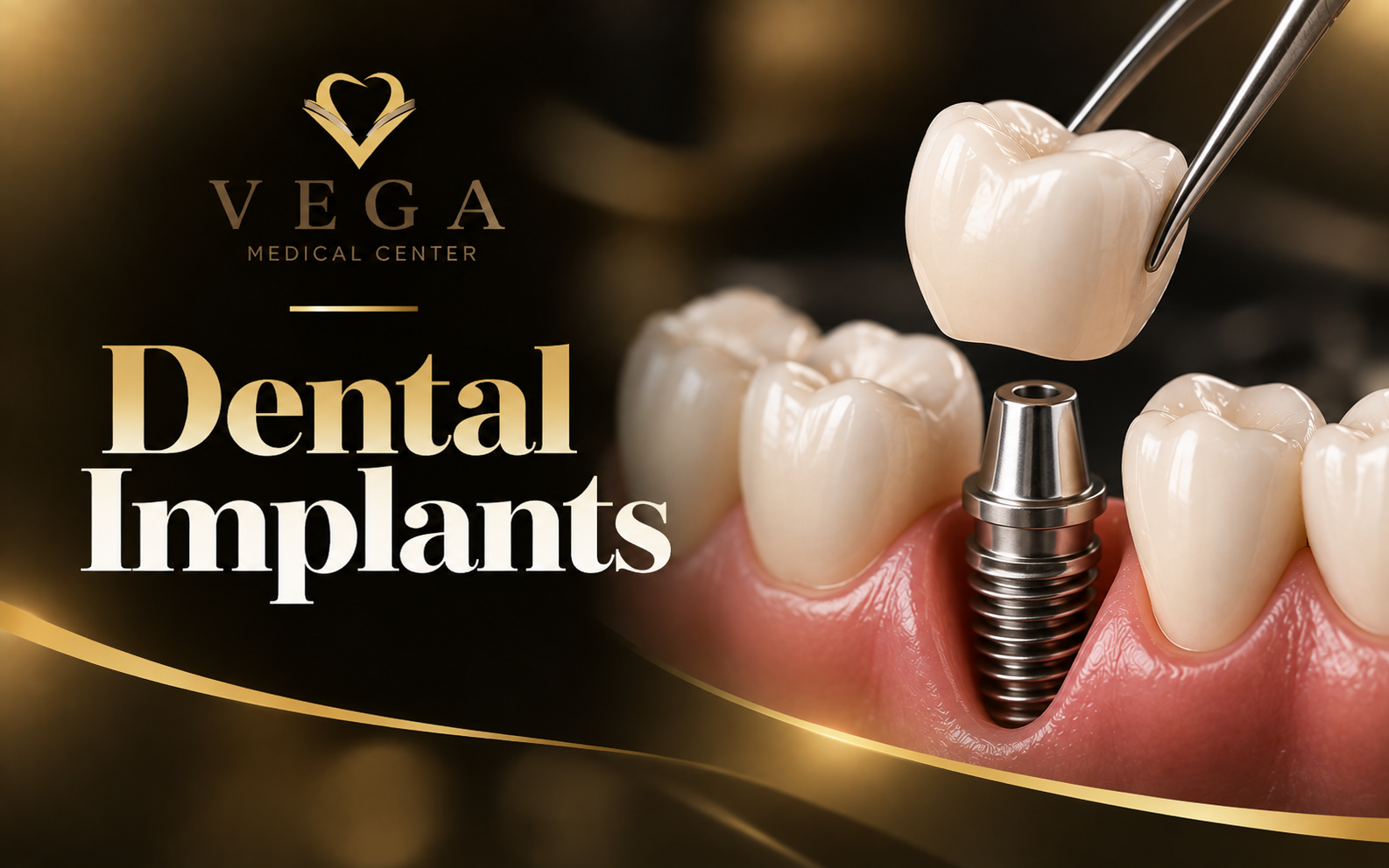 Dental implants at VEGA Medical Center, Al Rigga, Deira