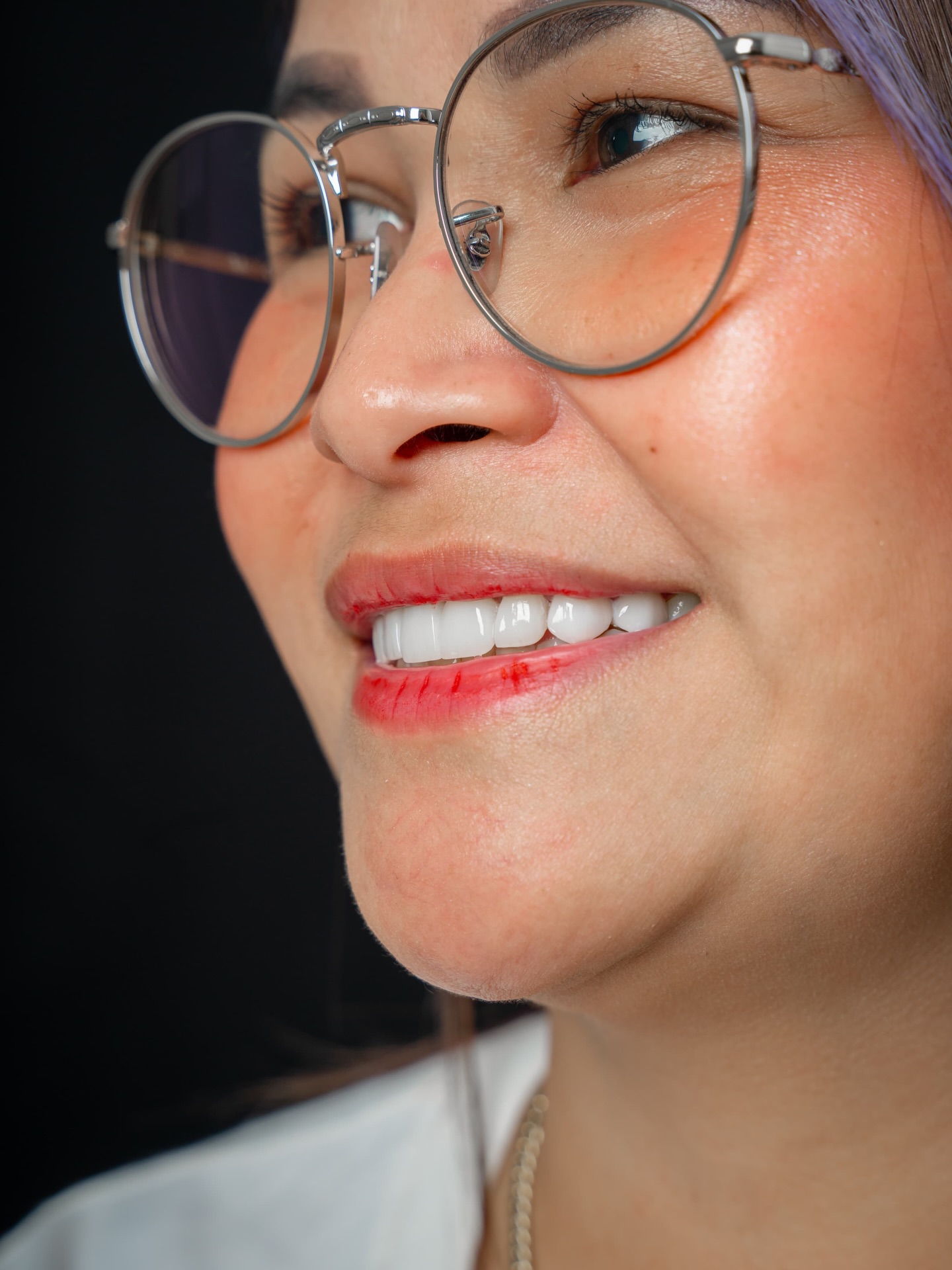 Veneers makeover - side profile smile