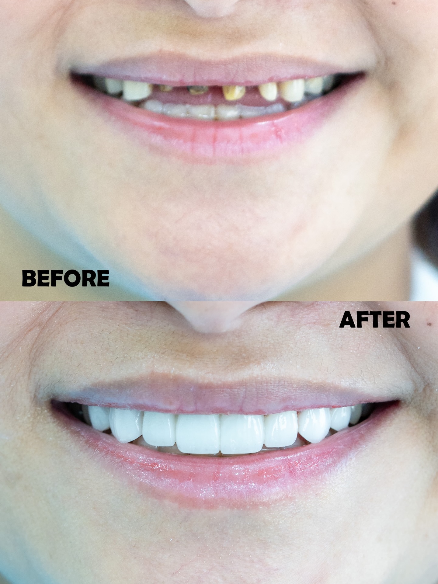 Before and after veneers makeover