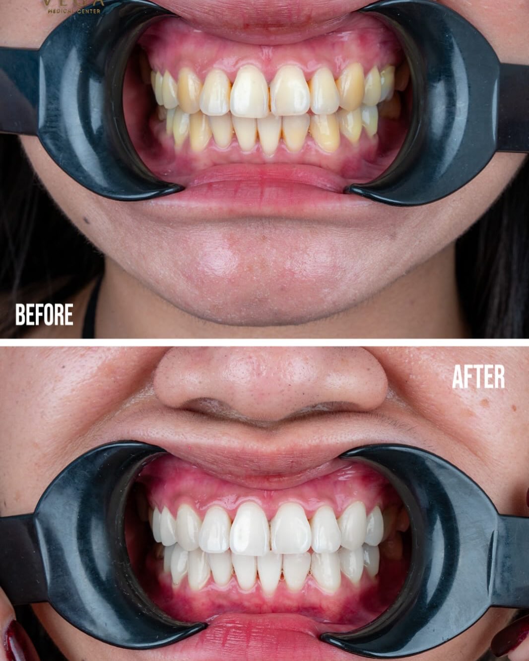 Philips Zoom teeth whitening before and after