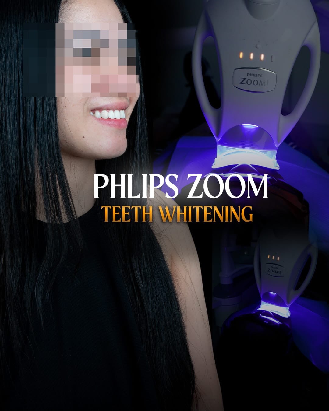 Philips Zoom teeth whitening result at Vega Medical Center