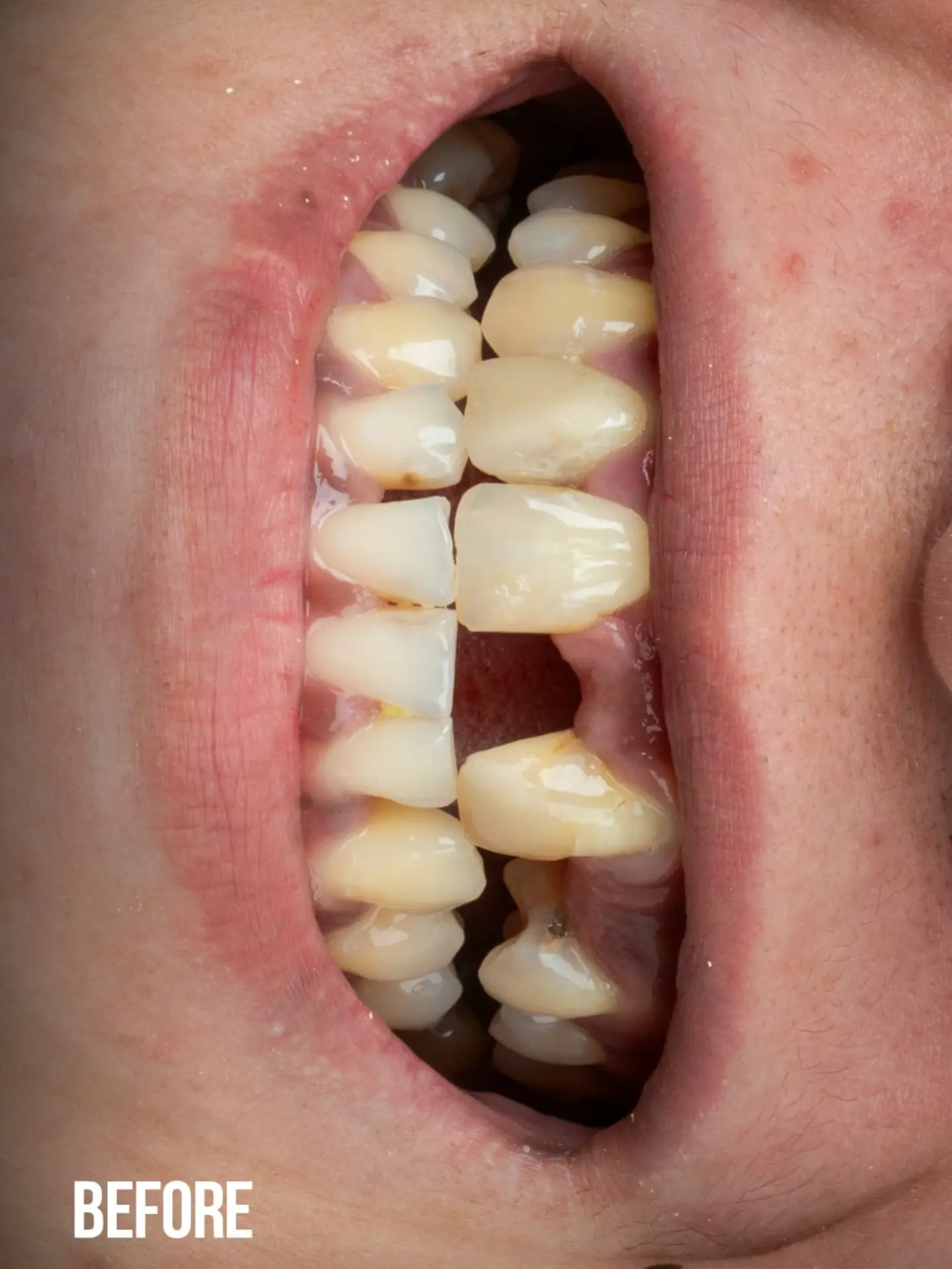 Veneers and bridges smile transformation