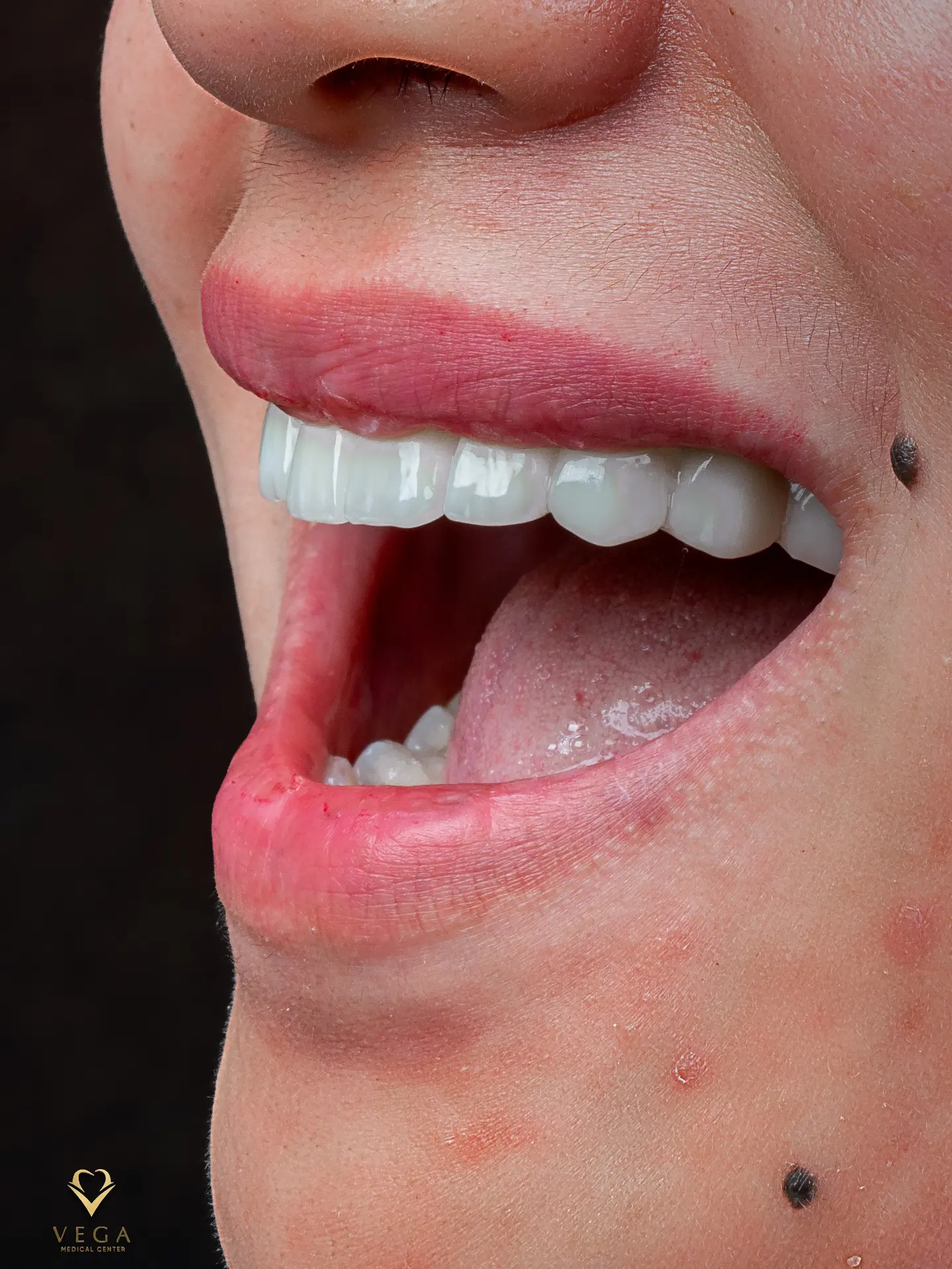 Veneers and bridges smile transformation