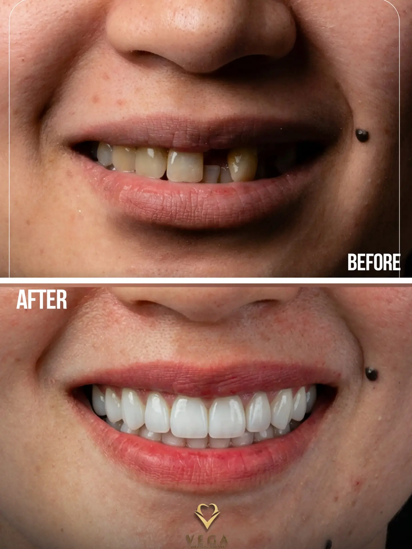 Veneers and bridges smile transformation