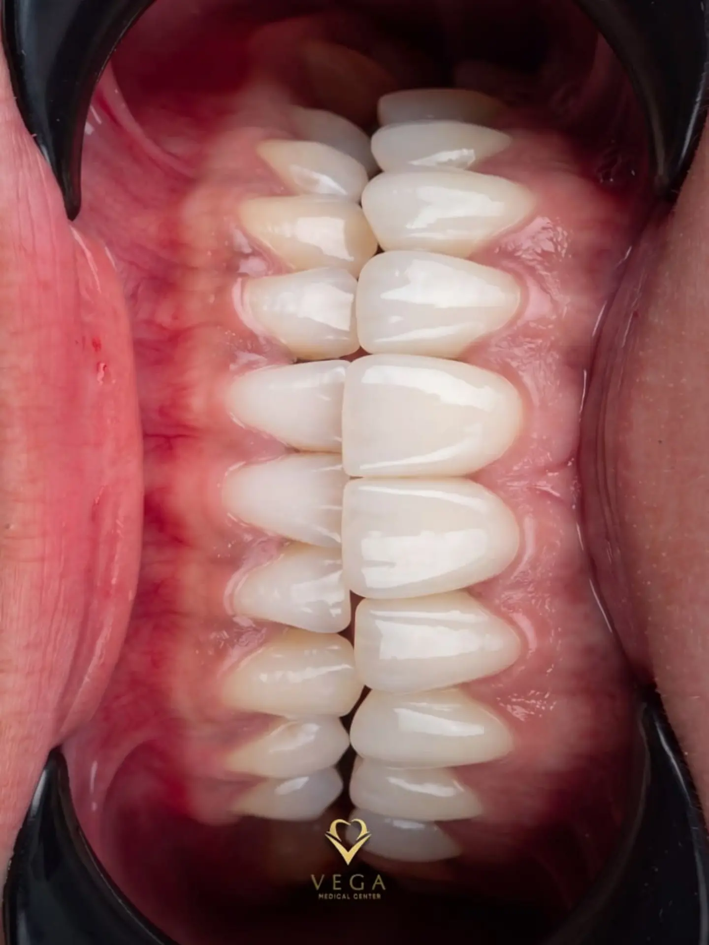 Veneers and bridges smile transformation