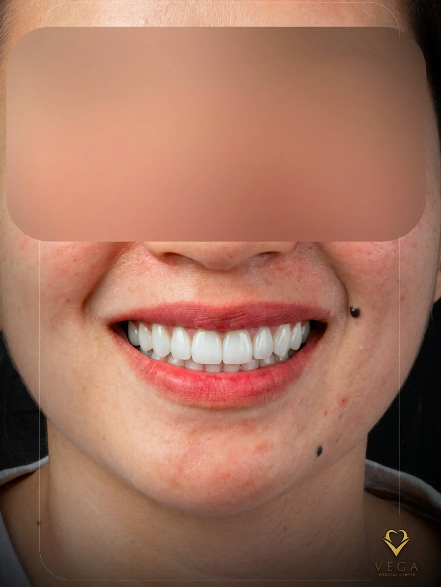 Veneers and bridges smile transformation