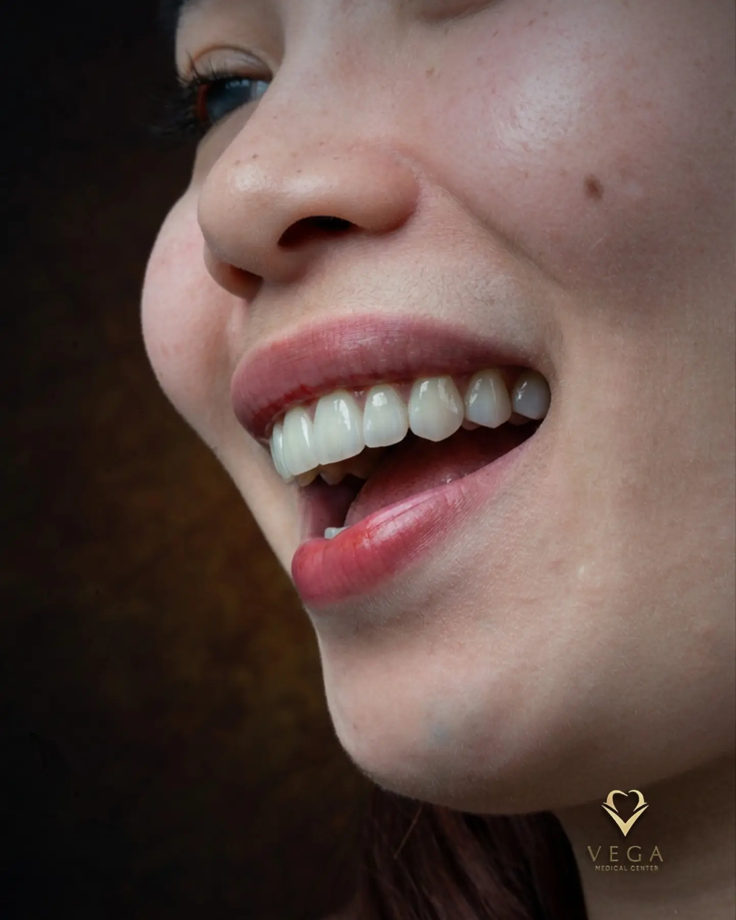 Dental crowns and bridges smile restoration
