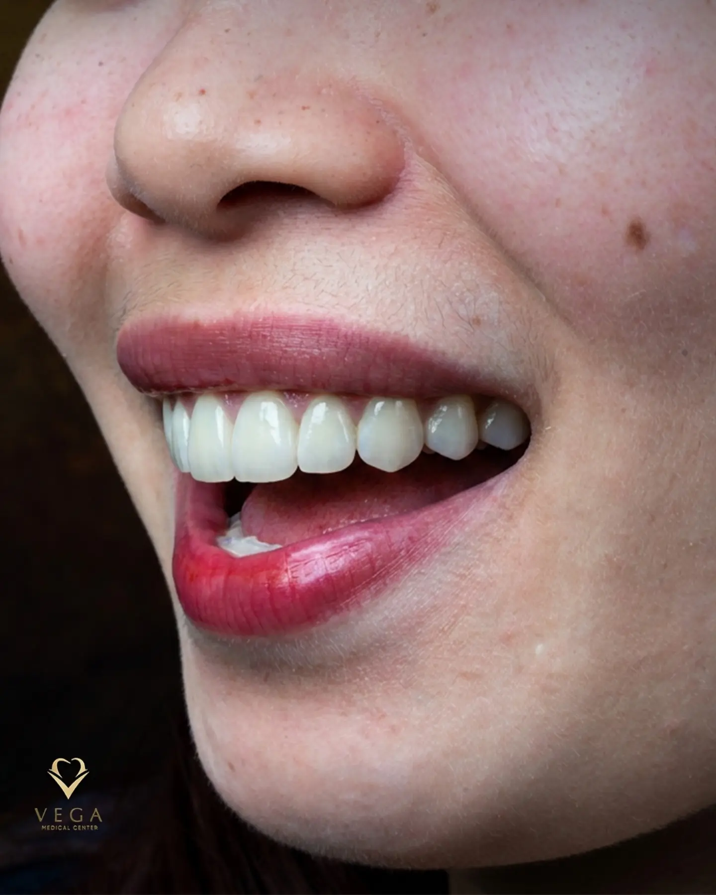 Dental crowns and bridges smile restoration
