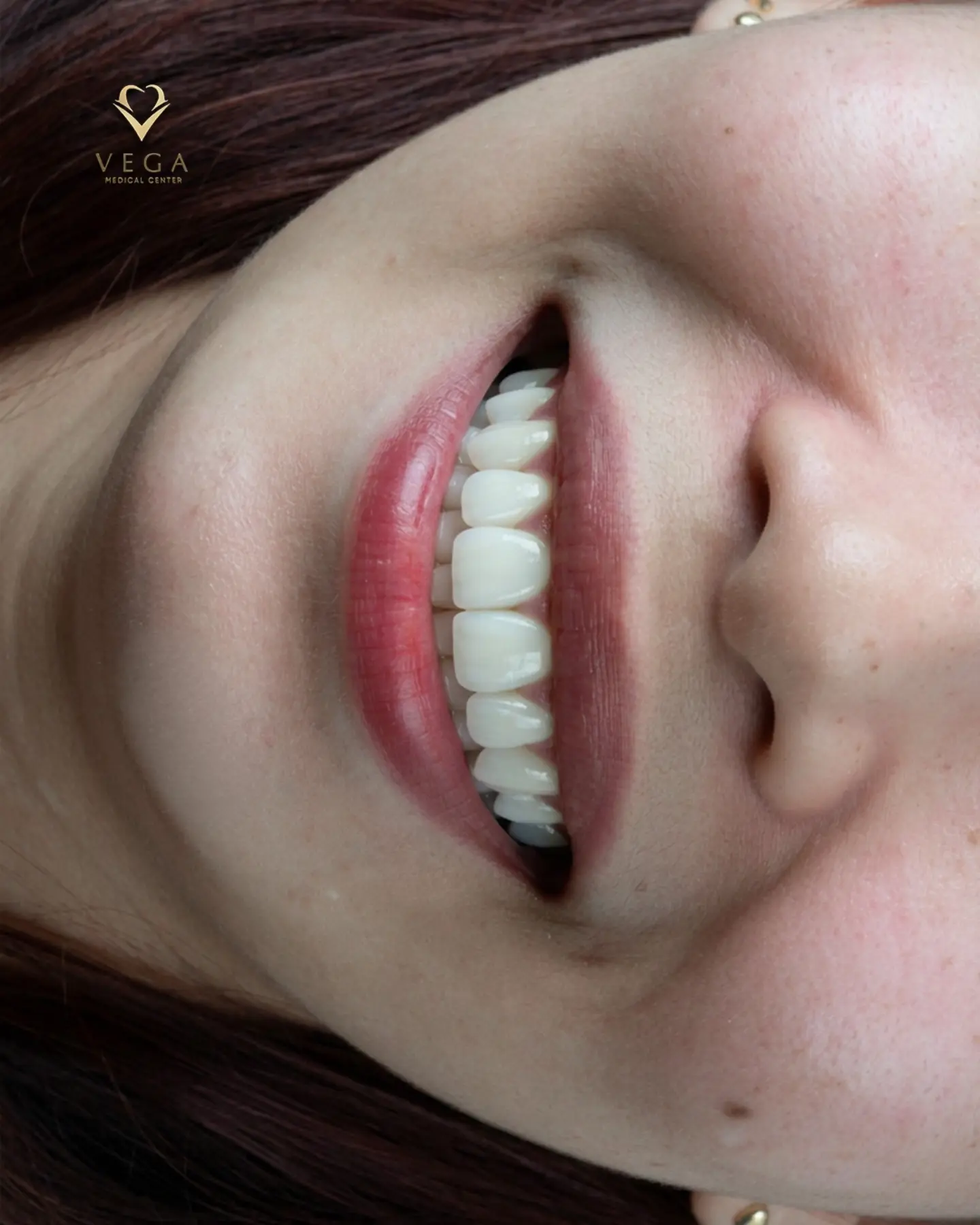 Dental crowns and bridges smile restoration