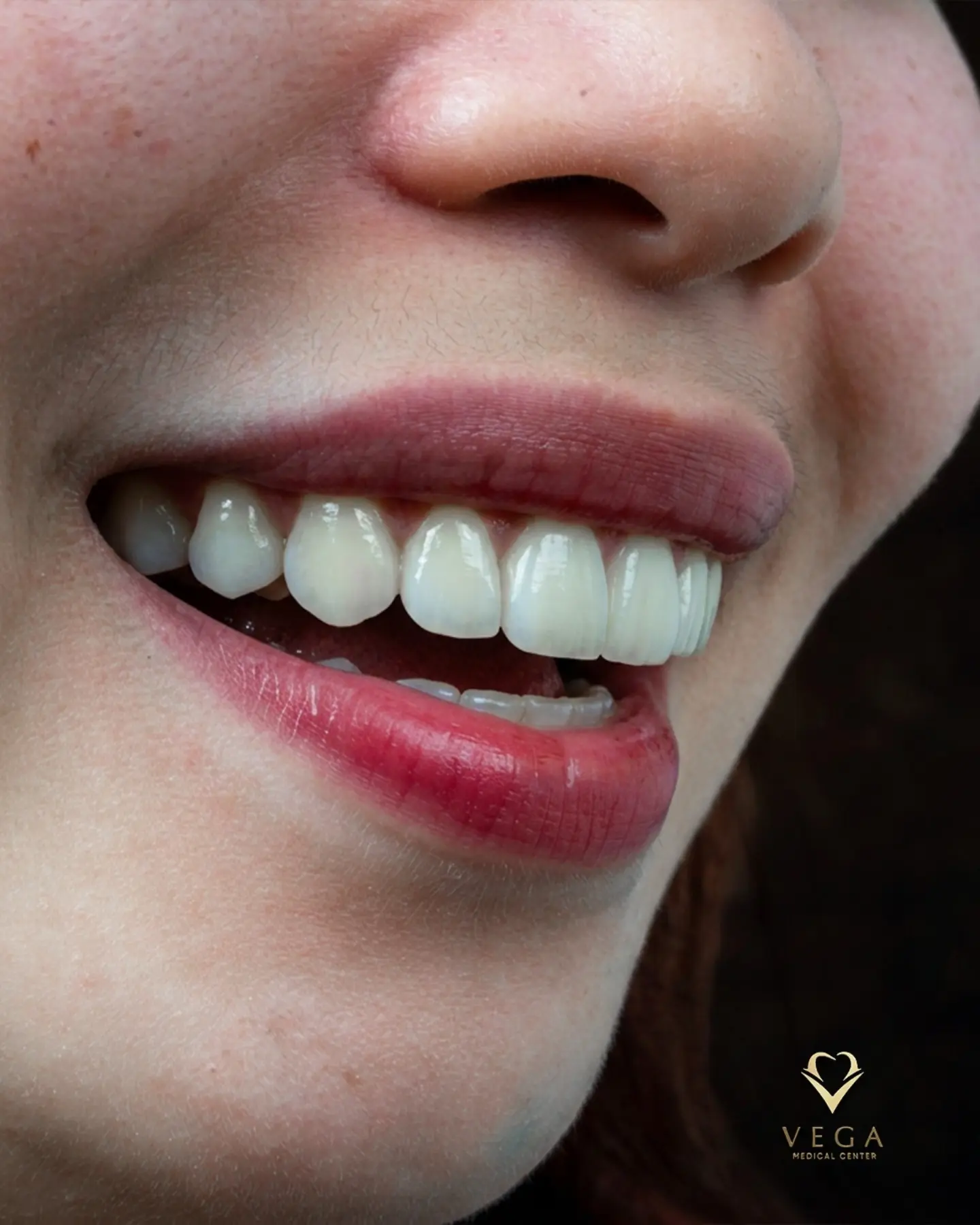 Dental crowns and bridges smile restoration