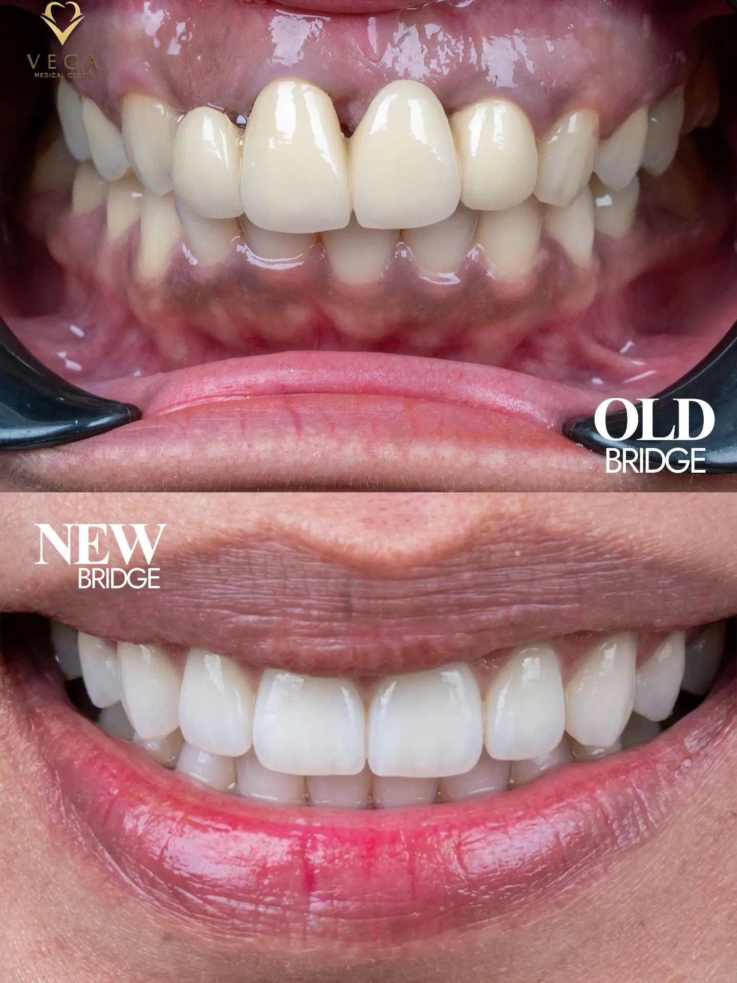 Dental bridge replacement smile transformation