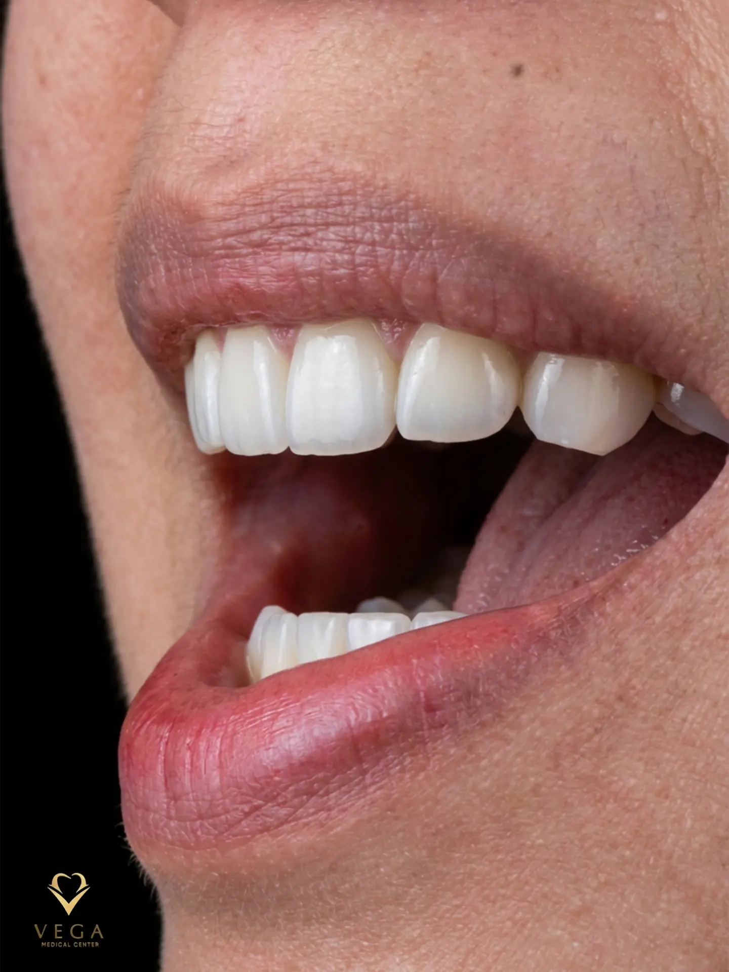Dental bridge replacement smile transformation