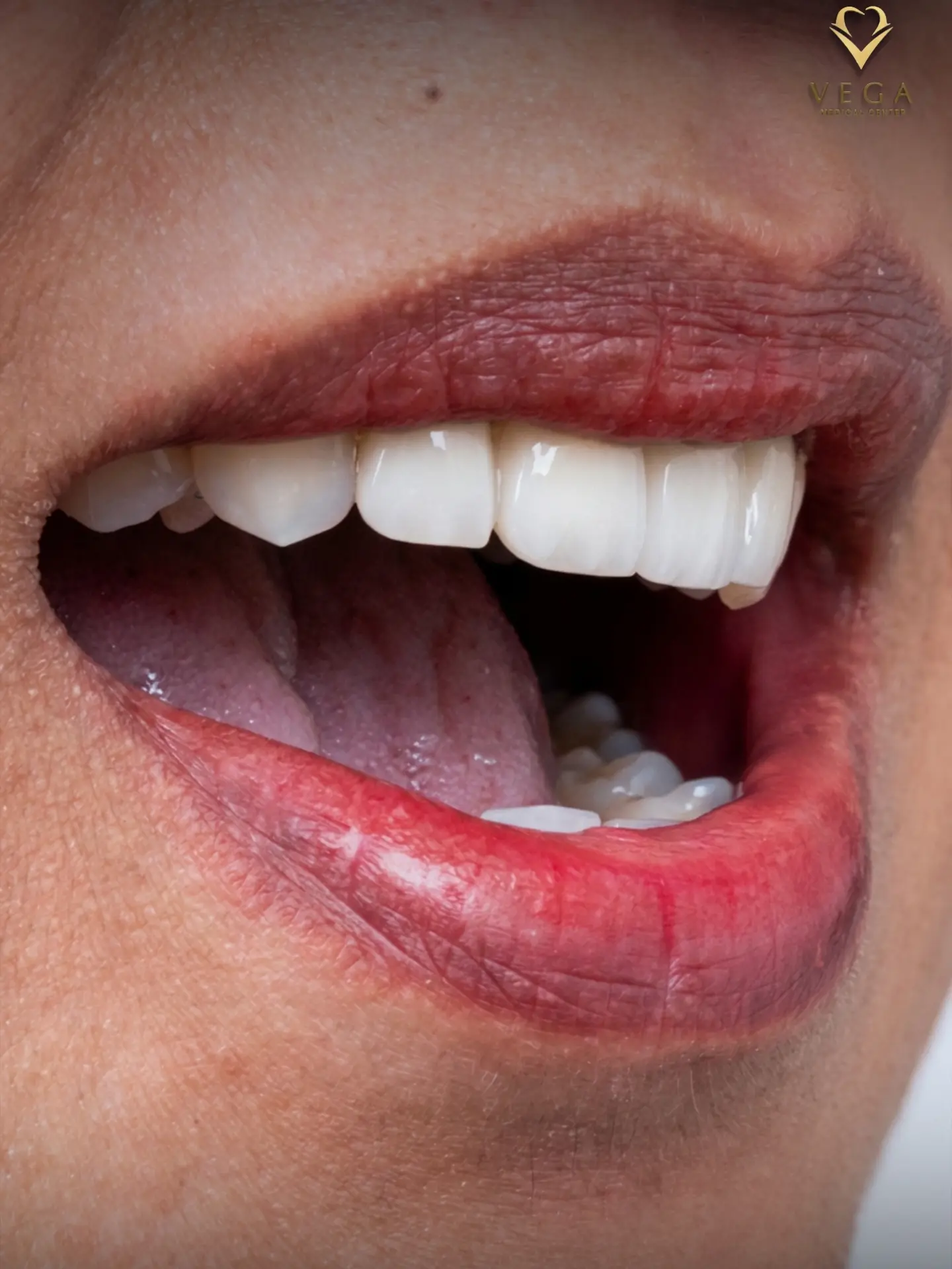 Dental bridge replacement smile transformation