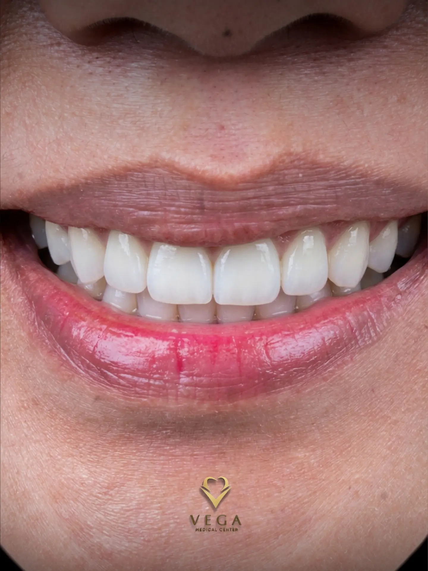Smile after replacing an old dental bridge at Vega Medical Center