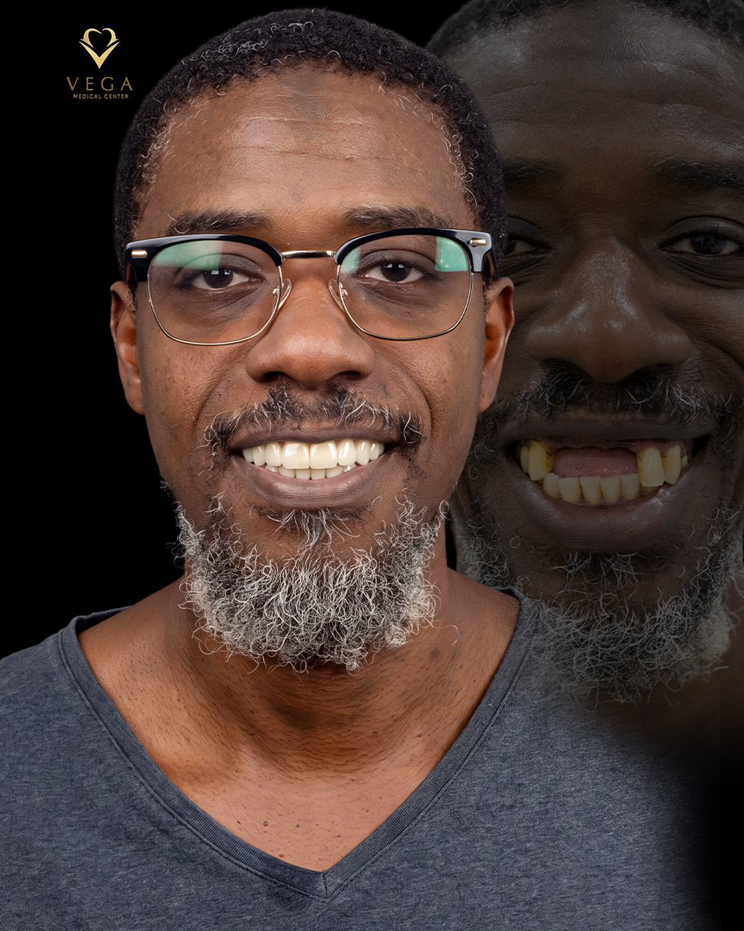Before and after dental bridge treatment